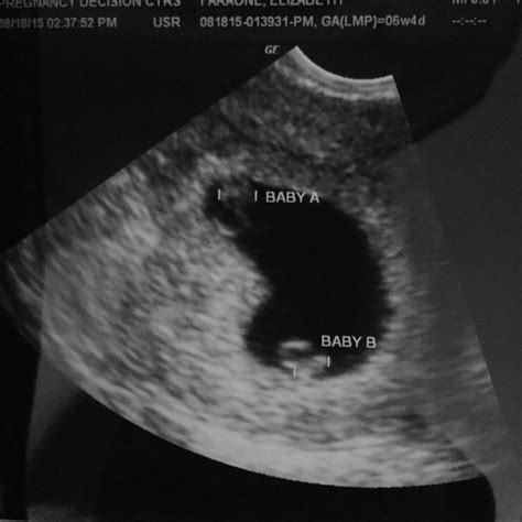 6 Week Ultrasound Twins One Sac