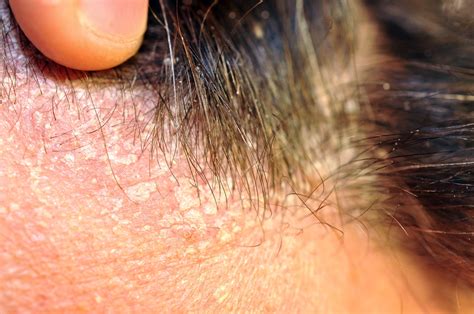 "Perioral and Seborrheic Dermatitis Treatment in Katy and Memorial Houston | Dr. Ashley Baldree"
