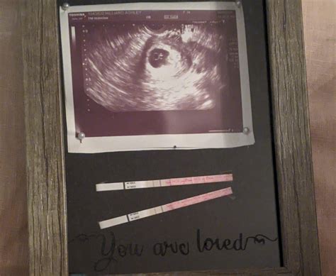 Miscarriage and pregnancy loss: Ashley’s story