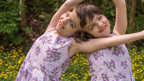 Inseparable: Ten Years Joined At The Head: Canada’s Hogan Twins Share A ...