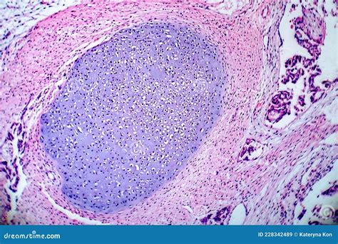 Teratoma, Light Micrograph Royalty-Free Stock Photography | CartoonDealer.com #228342353