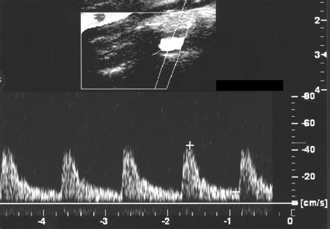 Carotid Doppler Ultrasound