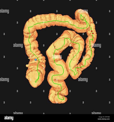 3D computed tomography (CT) scan of the colon Stock Photo - Alamy