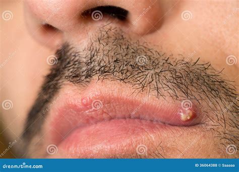 Pimple On Upper Lip