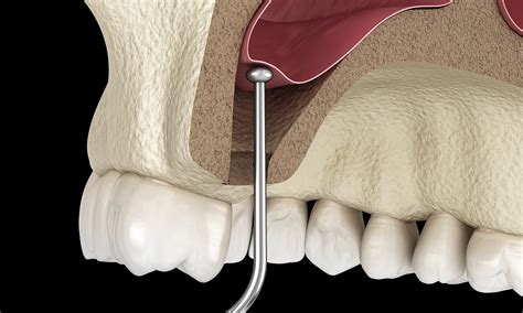 Sinus Bone Grafting for Campbell, CA | Ueno Center Dental Specialists | Board Certified ...