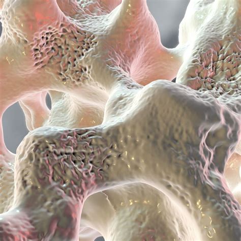 Romosozumab und Denosumab-Rebound - Orthopädie & Traumatologie ...