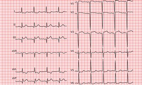 [Cardio-FR] Sequelae of an anterior infarct and inferior STEMI.