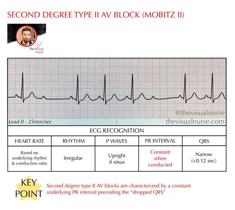 Second degree type II (Mobitz II) on the ECG for nurses & nursing students — The Visual Nurse