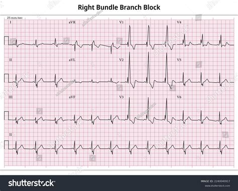 Ecg Rbbb Right Bundle Branch Block Stock Vector (Royalty Free) 2240040917 | Shutterstock
