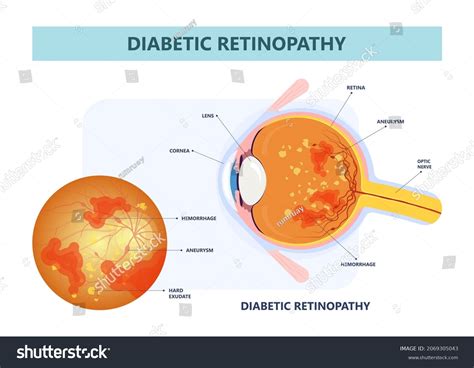 139 Fundus Hypertension Images, Stock Photos & Vectors | Shutterstock