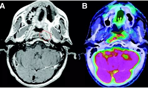 PET imaging aids in better target volume delineation over MRI in ...