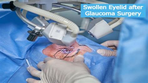 Understanding and Managing Swollen Eyelids After Glaucoma Surgery - Swollen Eyelid