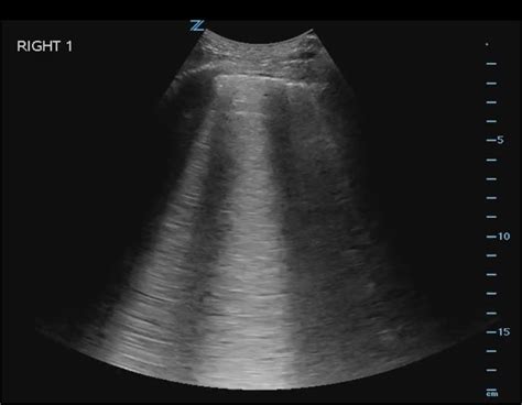 Design and rationale of the B-lines lung ultrasound guided emergency department management of ...