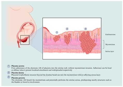 The Underlying Molecular Mechanisms of the Placenta Accreta Spectrum: A Narrative Review