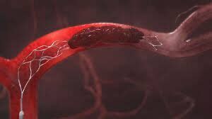 Use of adjunct intra-arterial alteplase beneficial in Patients with ...