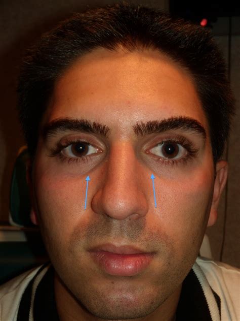 Sunken Eyes Before And After