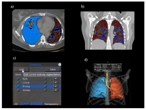 Different Lung Parenchyma Quantification Using Dissimilar Segmentation ...