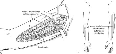Nerve repair and cable grafting in acute facial nerve injury ...