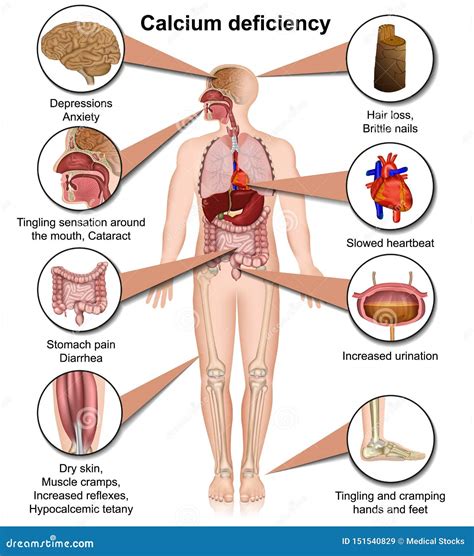 Calcium Deficiency. Sign, Symptoms, And Sources Cartoon Vector | CartoonDealer.com #170694795