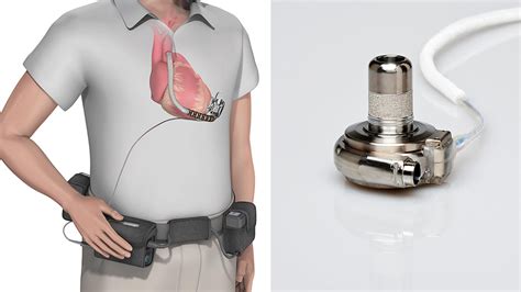 Lvad Heartmate Ii