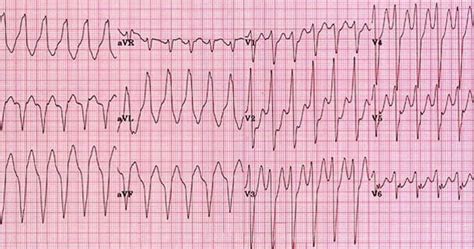 Cardiac Arrest. Shockable and Non-Shockable Rhythms.