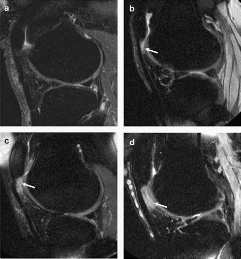 Figure 1 from Is superolateral Hoffa's fat pad hyperintensity a marker ...