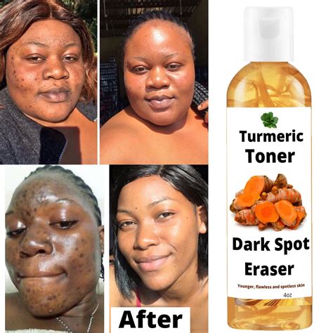 Acne Dark Spots Remover