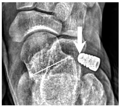 Body Weight Effects on Extra-Osseous Subtalar Arthroereisis