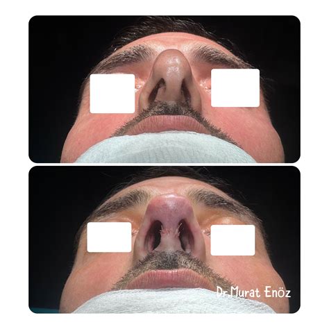 Septal Deviation, Nasal Polyposis, and Alar Collapse: A Functional and Aesthetic Approach
