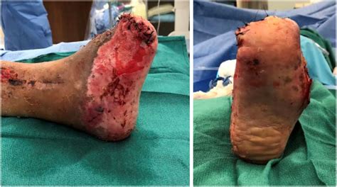 Necrotizing Fasciitis Leg