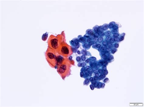Pathology Outlines - Cytology-neoplastic