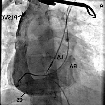 肺静脉图片 超声心动图对完全性肺静脉异位引流诊断价值的探讨_尚书坊