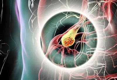 Gallbladder stones can turn deadly: Doctors explain when the condition ...