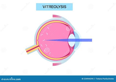 Vitreolysis Laser Treatment Stock Illustration - Illustration of visual, floater: 334944295