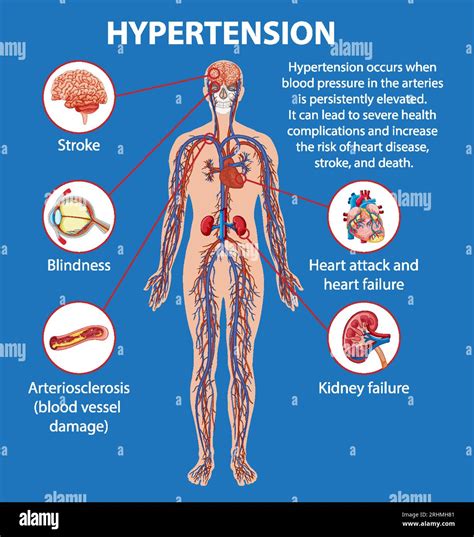 Hypertension Illustrations
