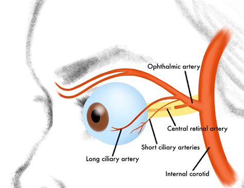 EyeRounds.org: Ocular Ischemic Syndrome