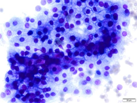 Salivary gland FNA – Saudi Society of Cytotechnology and Histotechnology
