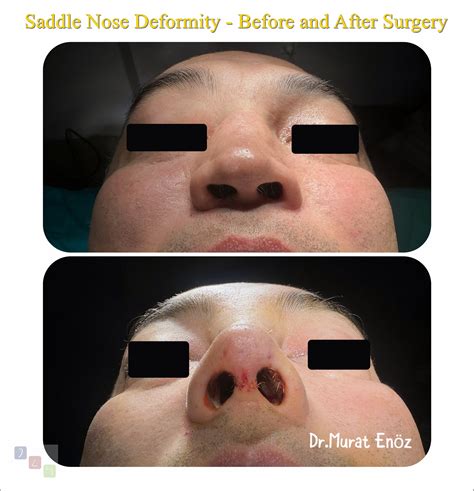 Saddle Nose Deformity: Understanding Causes, Diagnosis, and Treatment Solutions