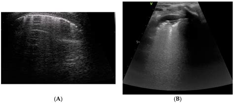 Overview of Lung Ultrasound in Pediatric Cardiology