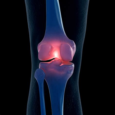 Osteoarthritis Treatment | Northeast Knee & Joint Institute