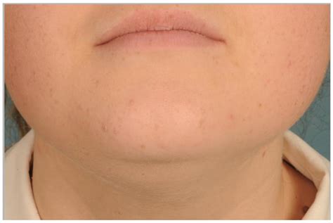 Image result for Exploding Mouth Cyst