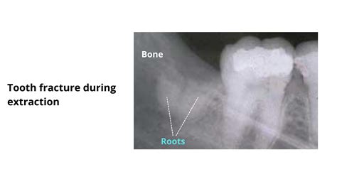 Image result for Root Extraction Tooth Broken Off