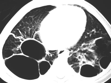 Pulmonary Interstitial Emphysema