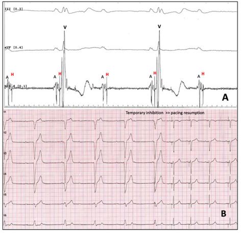 Cardiac Stimulation in the Third Millennium: Where Do We Head from Here?