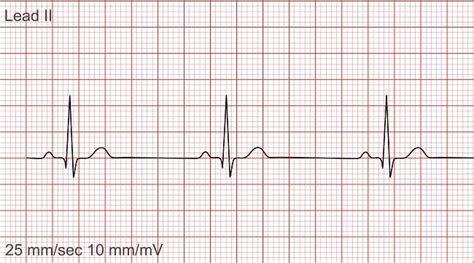 Patofisiologi Bradikardia - Alomedika