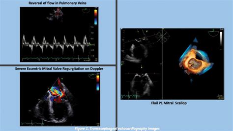 REFRACTORY HYPOXEMIA SECONDARY TO ACUTE RIGHT-TO-LEFT SHUNT RESULTING FROM SEVERE MITRAL VALVE ...