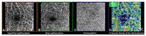 Retinal Vascularization Abnormalities Studied by Optical Coherence ...