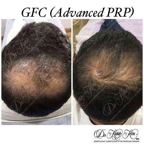 Advanced PRP Treatment in Delhi (GFC) | Hair Loss Treatment in Delhi