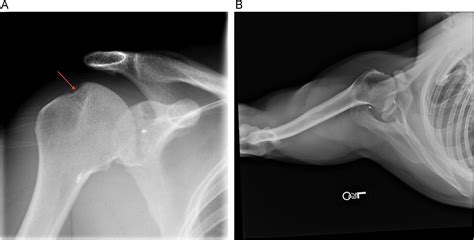 Hill–Sachs lesions are best treated with a surface replacement—Opposes - Seminars in ...