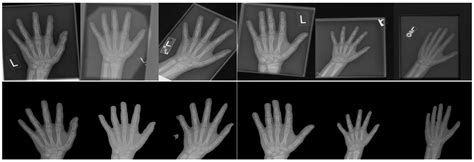 Bone Age X Ray Report at Dominique Ortega blog